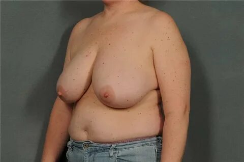 Saggy Tits-Breast Reduction 037 - 49 Pics xHamster