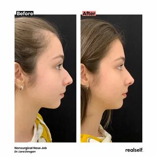 Bulbous Nose Non Surgical Nose Job Wide Nose - Dstudiocollec