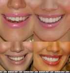 Kirsten Dunst Teeth Before And After