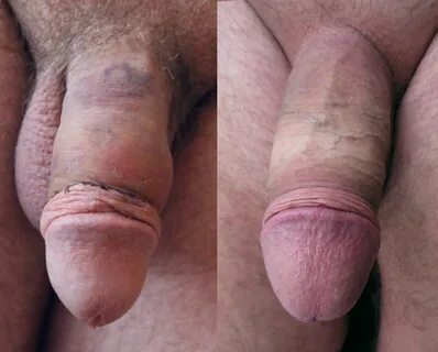 Circumcised Vs. Autocircumcised - Autocircumcision