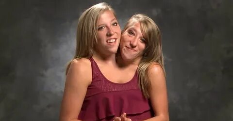 Where Are Conjoined Twins Abby and Brittany Hensel Today?