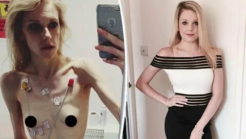 Una joven planta cara a la anorexia y logra pasar de 35 a 63