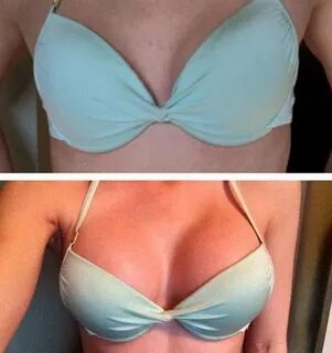 1000cc breast implants before and after pictures " Breast Au