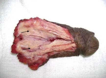 Penectomy specimen with 3.5 cm tumor in the proximal urethra