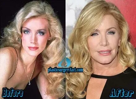 Shannon Tweed Plastic Surgery Before and After Photos - Plas