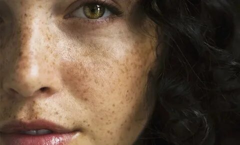 Пигментные пятна на лице: причины появления у женщин
