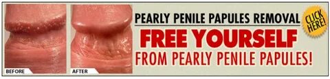 Pearly Papules Removal Easy And Quickly Online Elixir