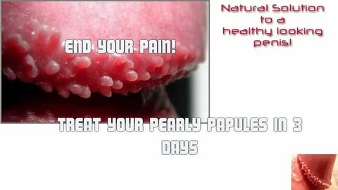 Treat your pearly penile papules in 3 days - YouTube