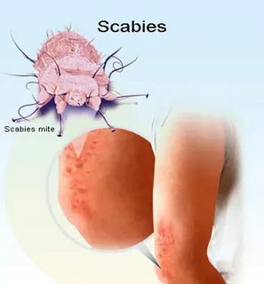 ChildHealth #17 : Scabies = Penyakit karena kutu Tungau - St