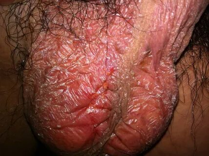 Yeast Infection Testicles Pics Guide