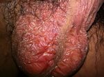 Yeast Infection Scrotum Pictures Guide