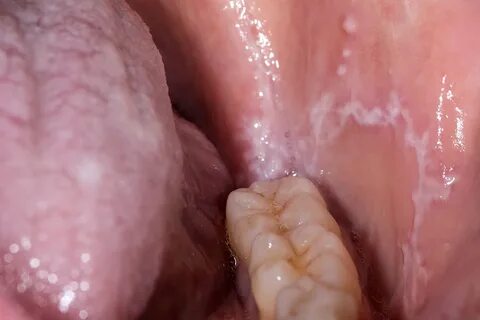 White tongue and bumps on cheeks and cums