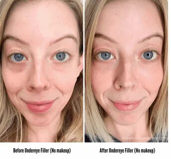 Under Eye Fillers for Dark Circles - Before & After Under ey