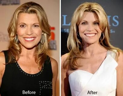 Vanna White plastic surgery before and after Plastic surgery