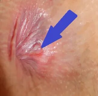 Anal fissure bleeding - Porn tube