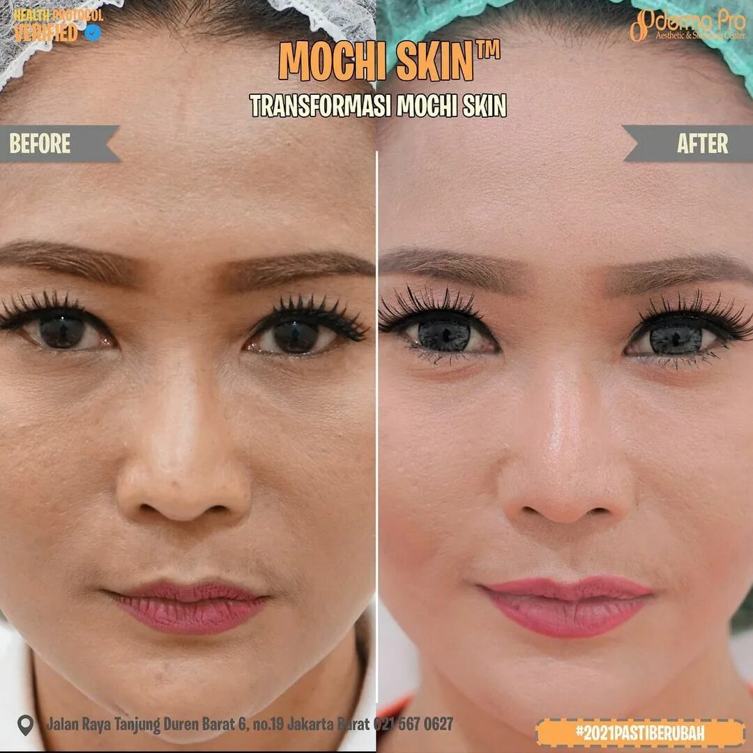 "Treatment Mochi Skin ™ Spesial yang hanya ada di Klinik Dermapro Jaka...