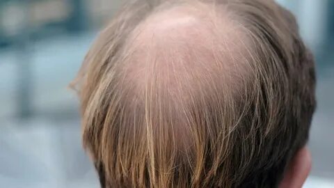 Kahle Stellen - Forscher finden Ursache für Haarausfall Augs