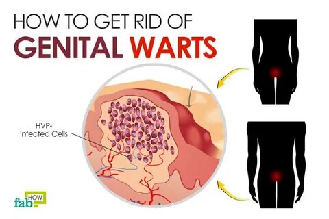 How to Get Rid of Genital Warts Fab How