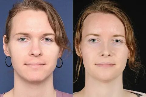 Alexandra before and after FFS - 2pass Clinic