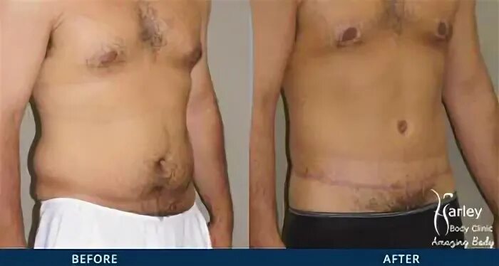Before After Photo of Gynecomastia Surgery Male Breast Reduc