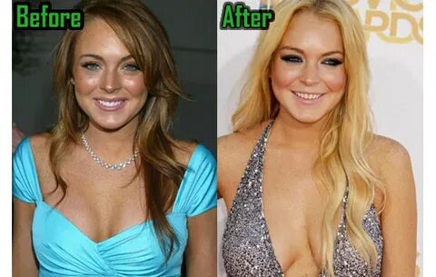 Lindsay Lohan Plastic Surgery Dramatically Changes Her Look!