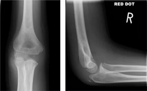 supracondylar fracture - Besko