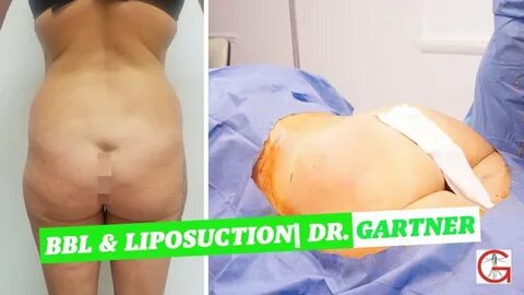 Brazilian Butt Lift BBL Fat Transfer Liposuction Dr. Gartner