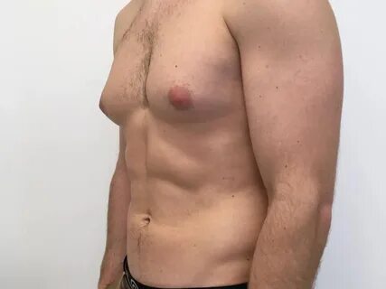 Man boobs, causes of Gynecomastia, gynecomastia treatment, gynecomastia dia...