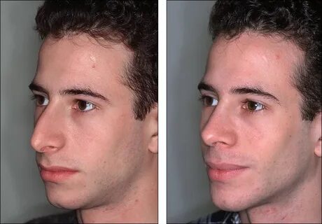 Dr. Steven Denenberg's facial plastic surgery before and aft