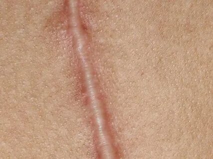 Frenulum beschneidung ✔ Erogenous Tissue Loss after Circumci