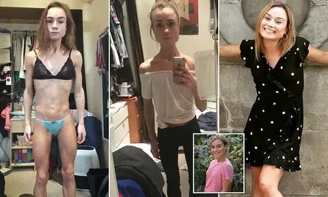 Anorexic ballerina labelled eating disorder a 'demon' Daily 