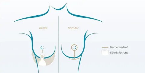 Bruststraffung: Methoden und Schnitte Brustoperation-Verglei