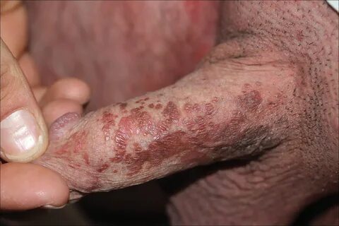 Brown Papules on the Penis MDedge Dermatology