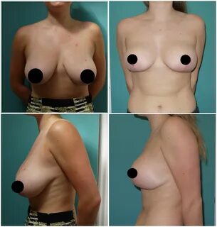 Breast Reduction Surgery, or Mammoplasty, treatment in a nutshell.