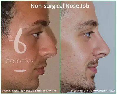 Pin on Non-Surgical Nose Job