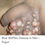 Blue Waffles Disease Pics - Captions Save