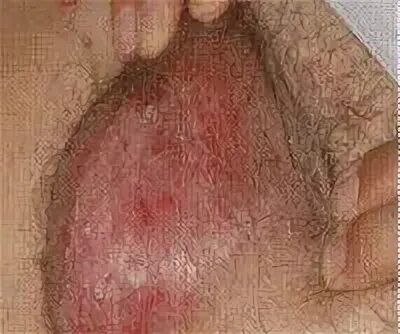 Болезнь Педжета вульвы - причины, симптомы, диагностика и ле