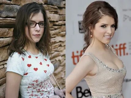 Did Anna Kendrick Get Surgery To Look HOT?