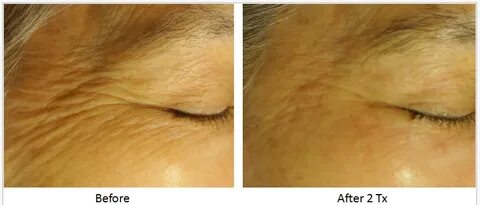 Skin Tightening, Facial Contouring Before & After SkinHealth