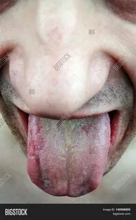 Disease Infection Image & Photo (Free Trial) Bigstock