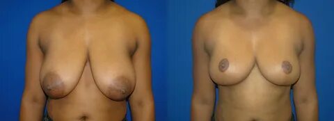 Breast Reduction Before & After Gallery - Patient 74827267 - Image 1.