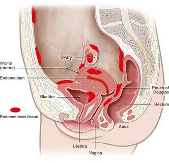 Endometriosis Belly - falljobros