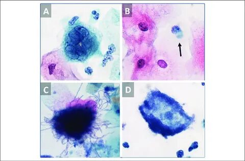 Common infectious findings on Pap smear: (A) herpes simplex 