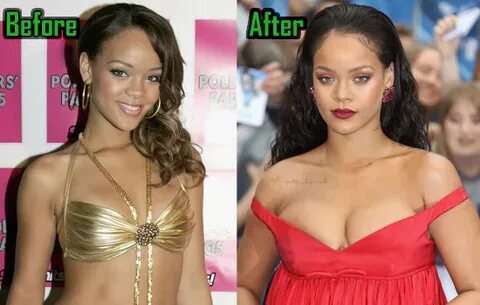 Rihanna Plastic Surgery: Perfect Nose Job? Before & After! -