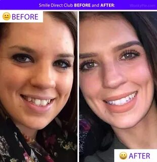 Smile Direct Club Before & After Photos, Results, Transforma