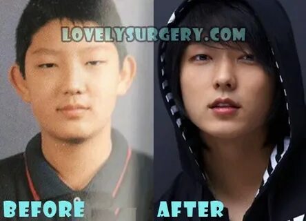 Lee Joon Gi Plastic Surgery Before and After Rhinoplasty Rum