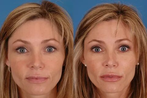 Facial Fillers Before & After Photos Dr. Bassichis