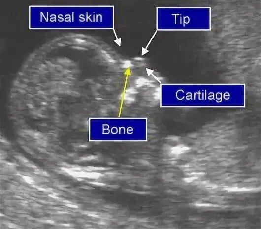 Nuchal Scan - Diagnostic Ultrasound
