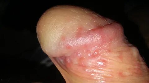 Red dots on pinus Red spots on penis (Pictures included!
