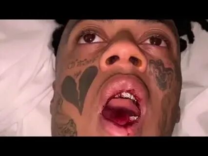 Boonk Gang Gets His Front Bottom Teeth Knocked Out and Jaw B
